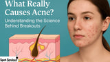 What Really Causes Acne Understanding the Science Behind Breakouts