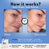 Before and after 6 hours result using Spot Saviour hydrocolloid pimple patches – visible reduction in acne and redness