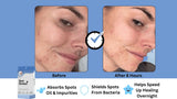 How Spot Saviour hydrocolloid pimple patches work – absorbs oil, protects skin, heals blemishes overnight.