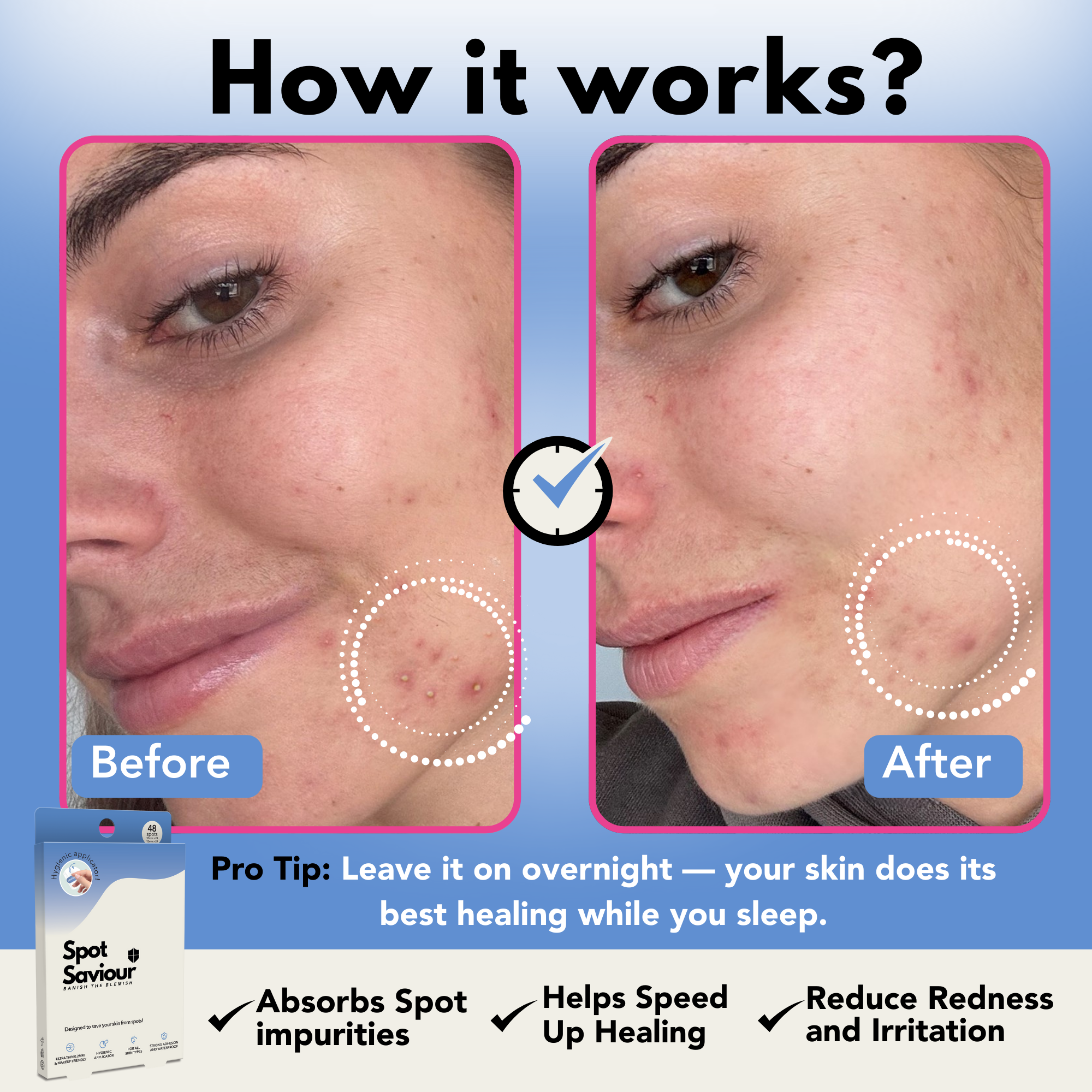 SPOT SAVIOUR Pimple Patches | 96 Hydrocolloid Spot Patches – Fast-Acting, Hygienic, Ultra-Thin, Dermatologist-Tested